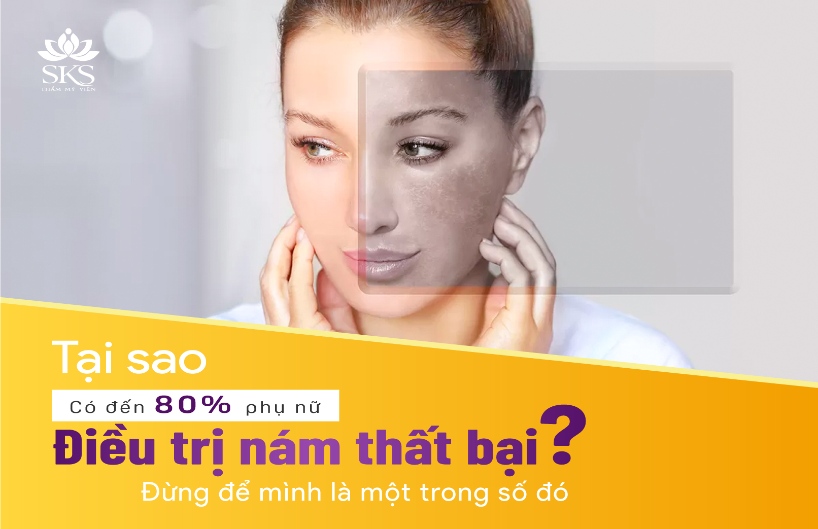 Tại sao có đến 80% phụ nữ điều trị nám thất bại? Đừng để mình là một trong số đó