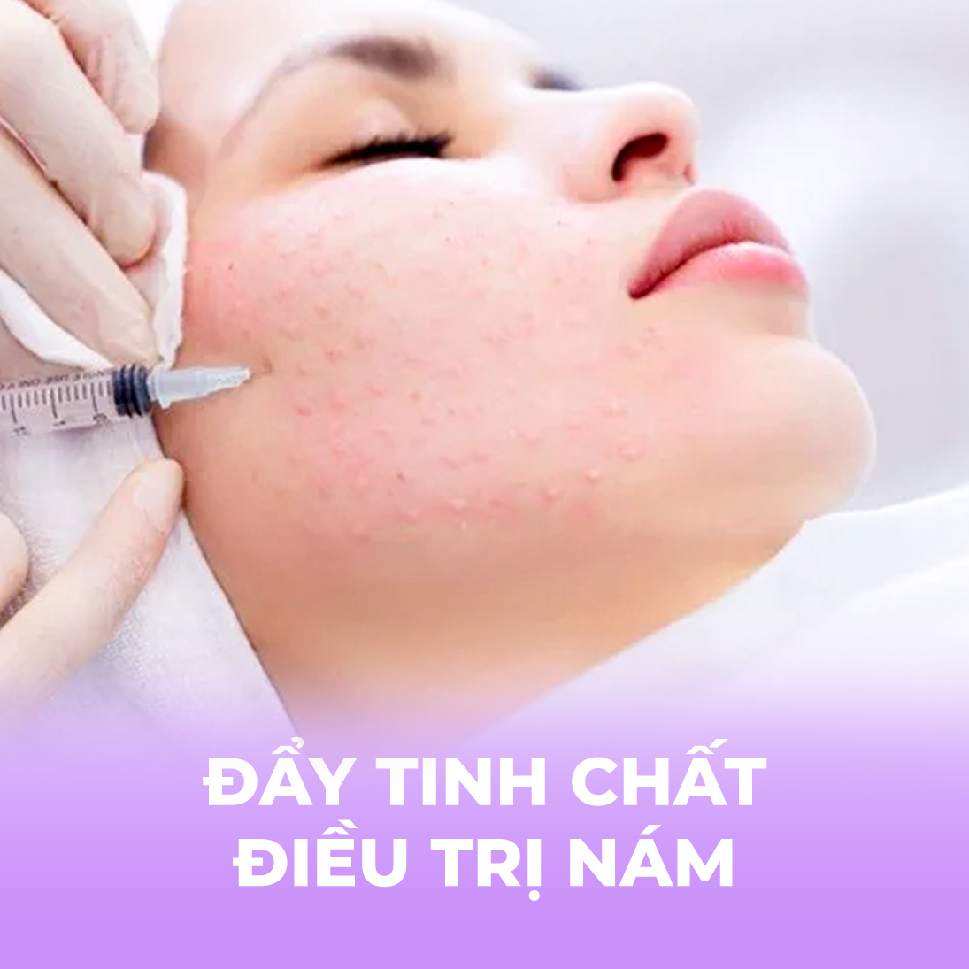 Đẩy tinh chất điều trị nám - 1 buổi