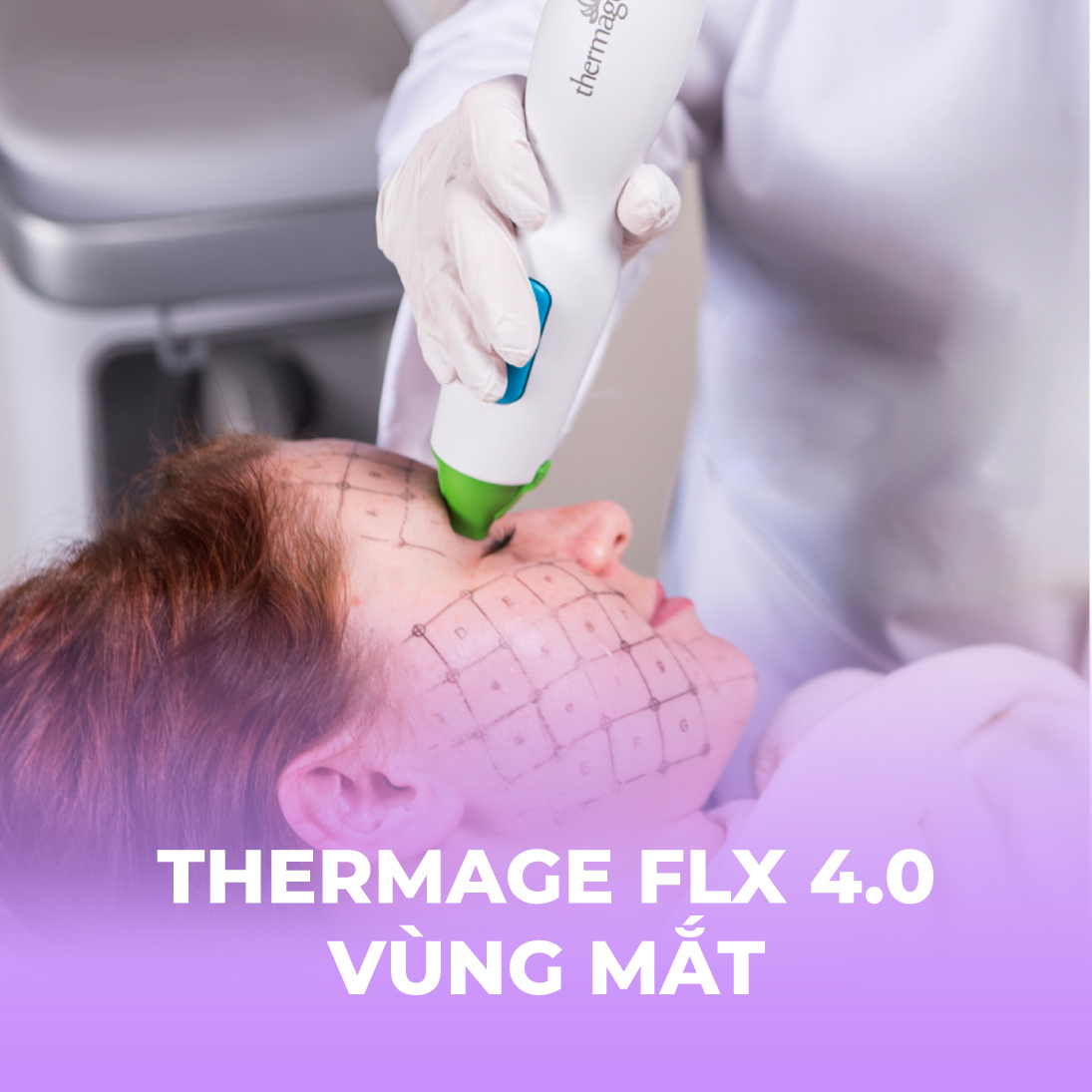 Thermage FLX 4.0 vùng mắt - 1 buổi