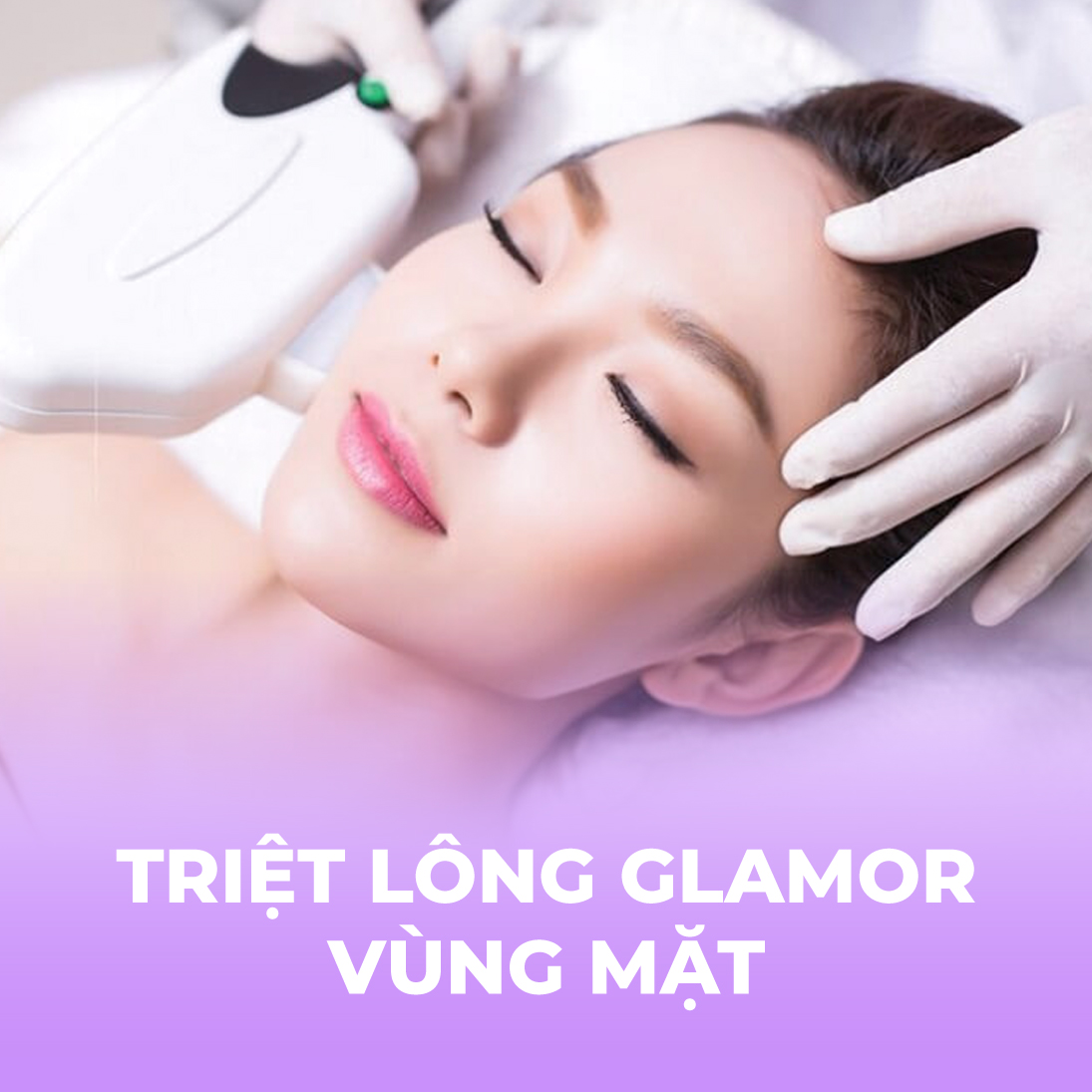 Triệt lông Glamor - Vùng mặt - 10 buổi