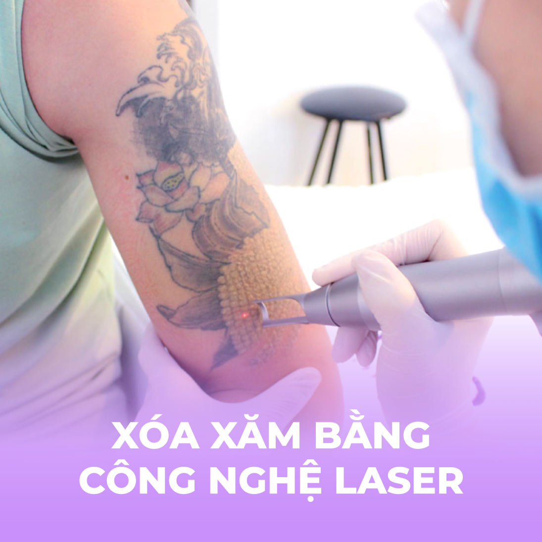 Xóa xăm lông mày - 3 buổi