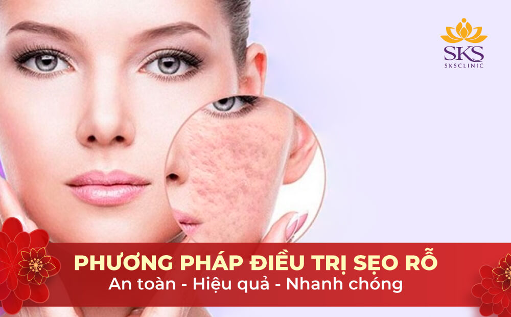 PHƯƠNG PHÁP ĐIỀU TRỊ SẸO RỖ AN TOÀN - HIỆU QUẢ - NHANH CHÓNG