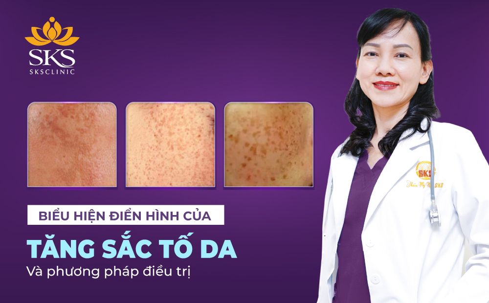 BIỂU HIỆN ĐIỂN HÌNH CỦA TĂNG SẮC TỐ DA VÀ PHƯƠNG PHÁP ĐIỀU TRỊ