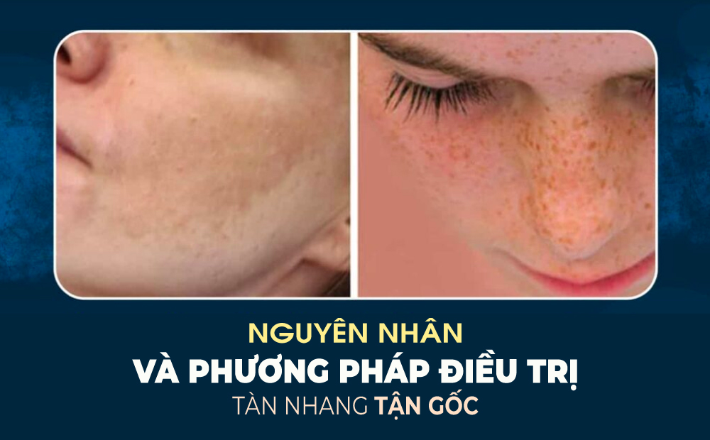 NGUYÊN NHÂN VÀ PHƯƠNG PHÁP ĐIỀU TRỊ TÀN NHANG TẬN GỐC