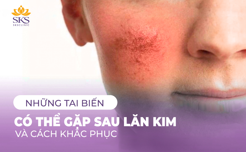 NHỮNG TAI BIẾN CÓ THỂ GẶP SAU LĂN KIM VÀ CÁCH KHẮC PHỤC