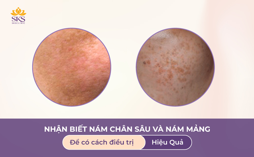 NHẬN BIẾT NÁM CHÂN SÂU VÀ NÁM MẢNG ĐỂ CÓ CÁCH ĐIỀU TRỊ HIỆU QUẢ