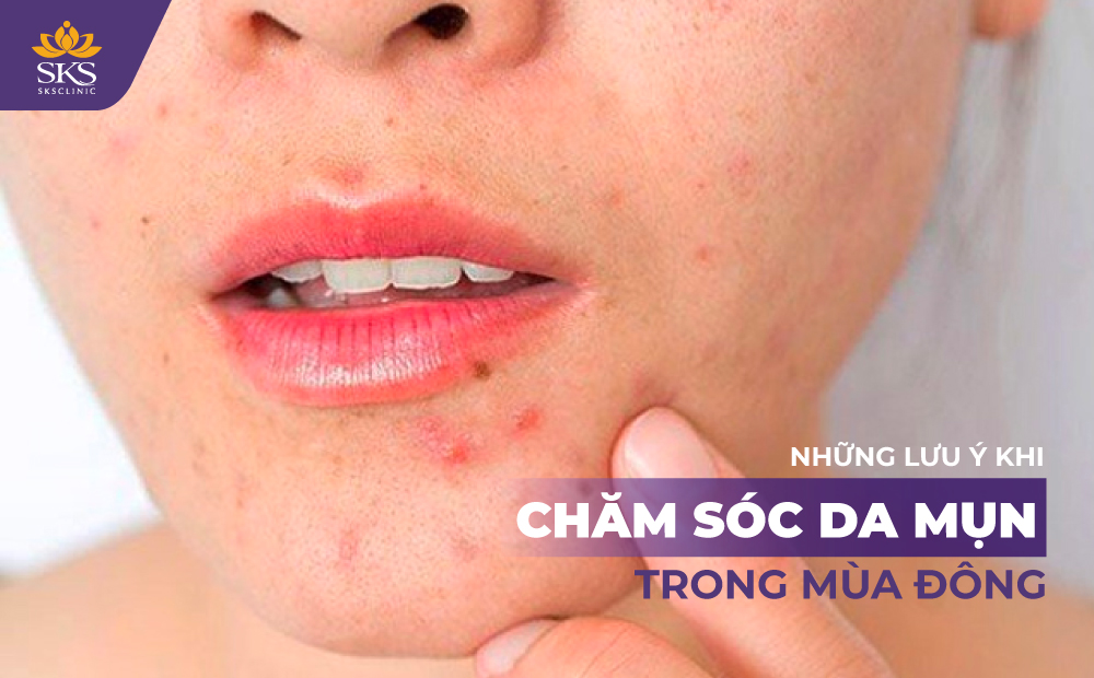 LỜI KHUYÊN TỪ CHUYÊN GIA - NHỮNG LƯU Ý KHI CHĂM SÓC DA MỤN TRONG MÙA ĐÔNG