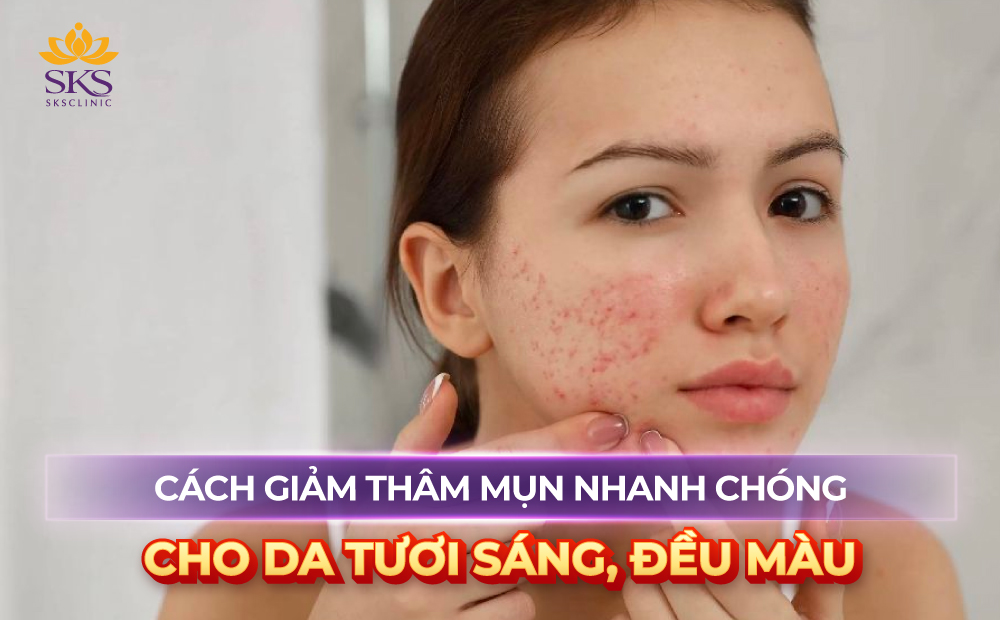 TOP 10 CÁCH GIẢM THÂM MỤN NHANH CHÓNG CHO DA TƯƠI SÁNG, ĐỀU MÀU