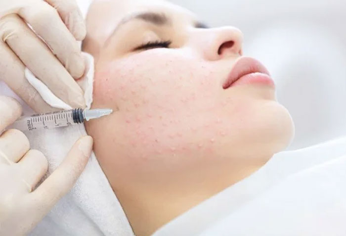/Upload/image/2024/09/30/upload_-mesotherapy-1_30-09-2024-11-13-14.jpg