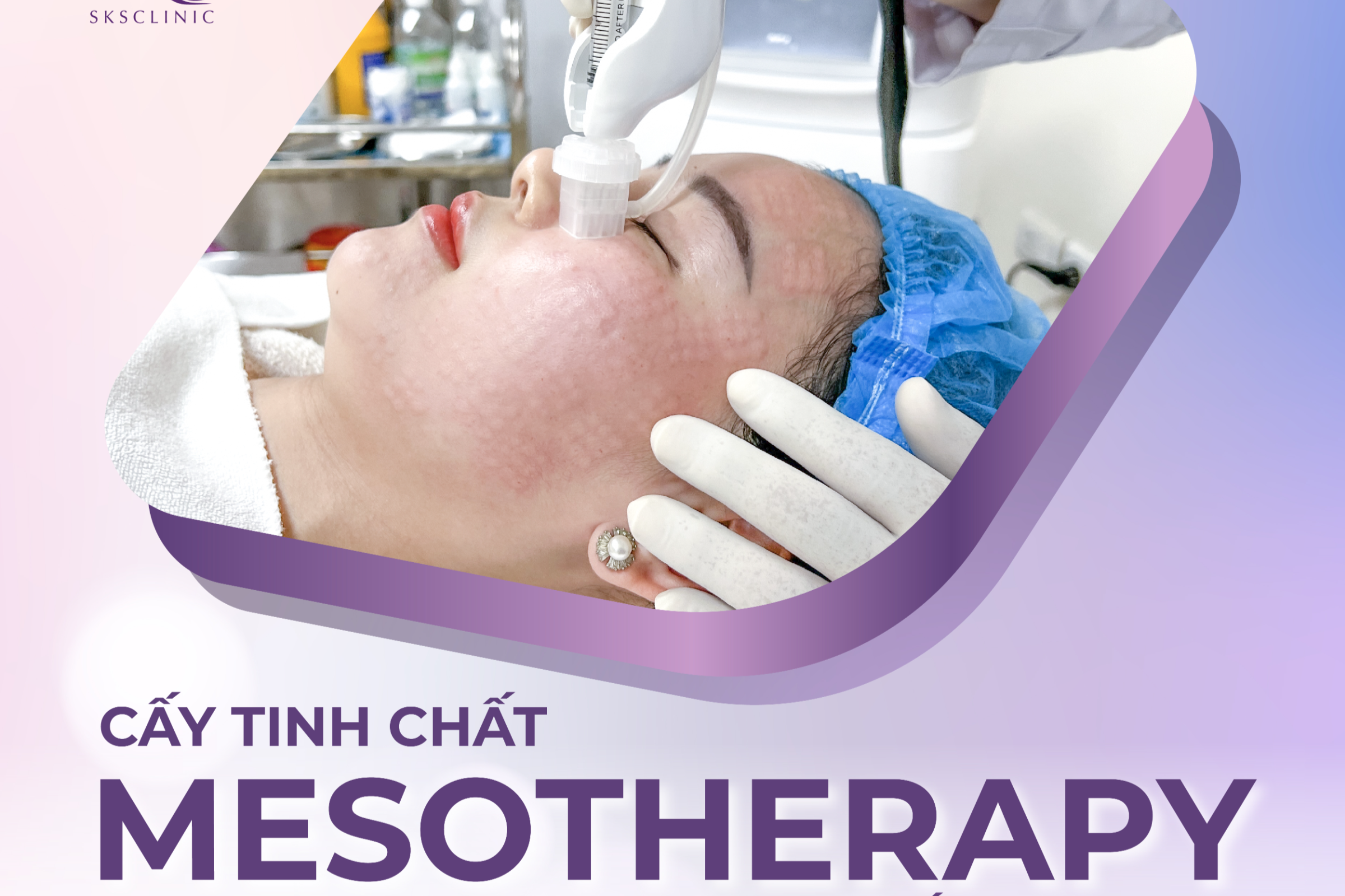 TÌM LẠI LÀN DA TUỔI ĐÔI MƯƠI VỚI LIỆU TRÌNH CẤY TINH CHẤT MESOTHERAPY